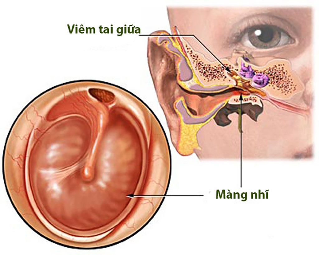 Bệnh viêm tai giữa 