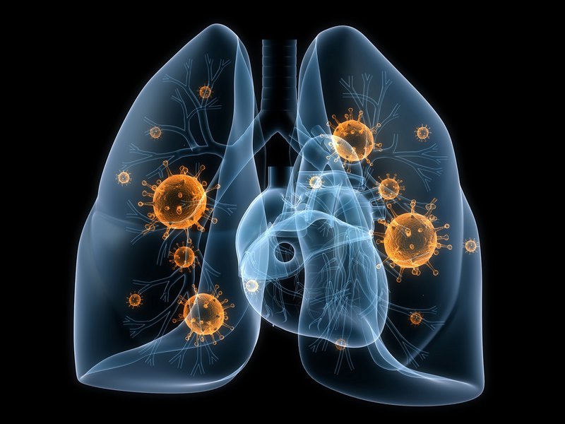 Cách điều trị căn bệnh viêm phổi