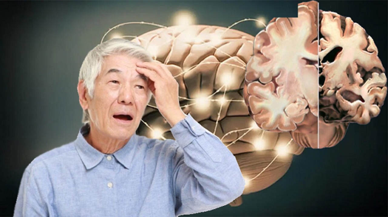 Một vài thông tin về căn bệnh Alzheimer