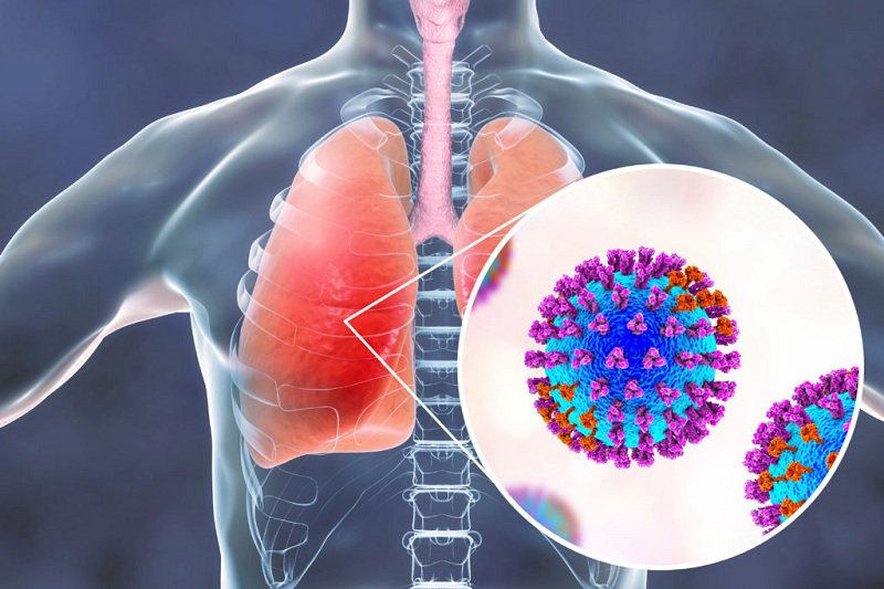 Tổng hợp những thông tin cơ bản về bệnh viêm phổi
